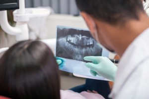 image of dental fillings