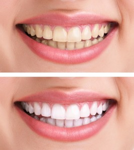 image of teeth whitening